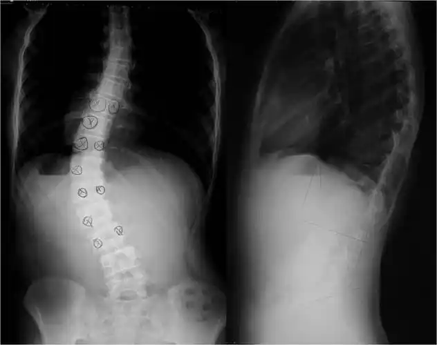 孩子发现脊柱侧弯该如何治疗? - 好大夫在线