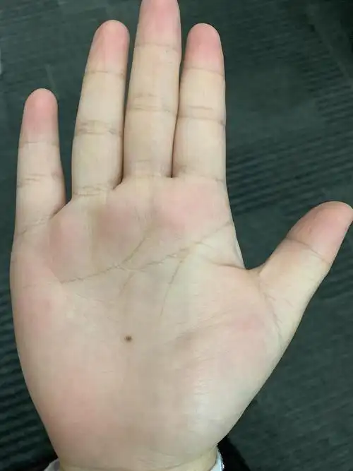 上大学后手掌心长了一颗痣有说法吗