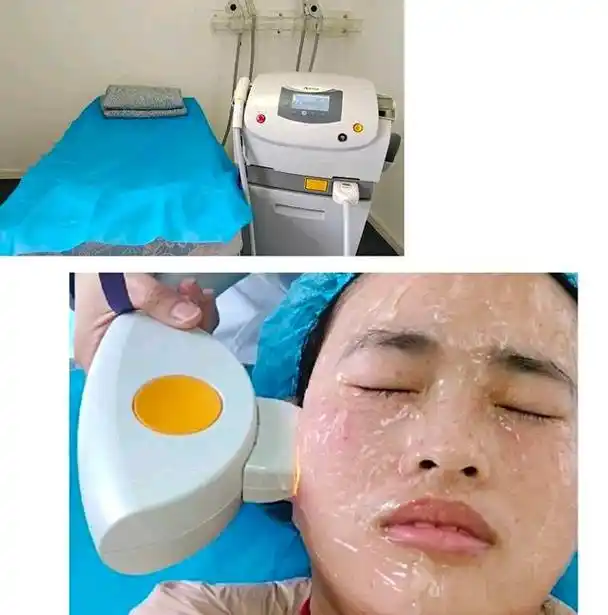 光子嫩肤术后11天,多年的斑点变淡了!