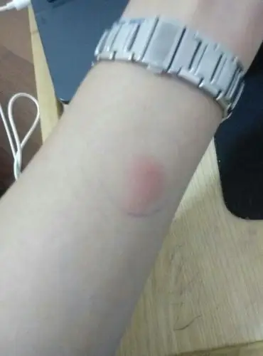 昨天下午做了肺结核皮试,这个样子有没有事