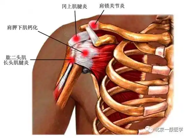 肱骨大结节——冈上肌腱损伤结节间沟——肱二头肌长头腱鞘炎肩部常见