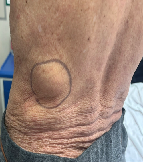 【卓越医疗】邵阳学院附属第一医院成功开展一例腹腔