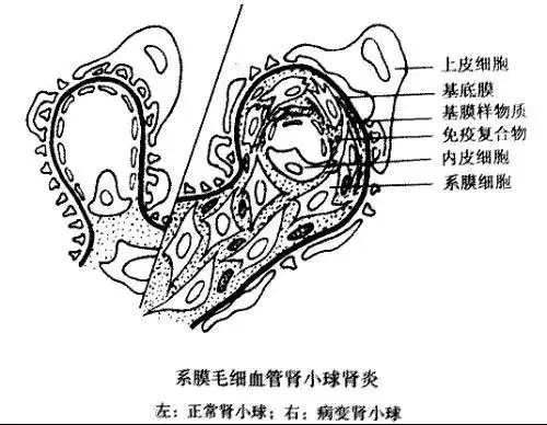 急骤进行性肾小球肾炎