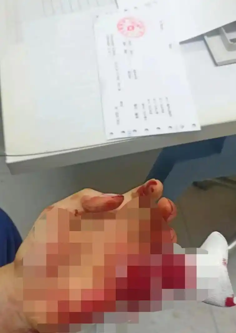 一拳吧玻璃打碎了吧小手指切了一半留了小半斤,兄弟们等我康复继 - 抖