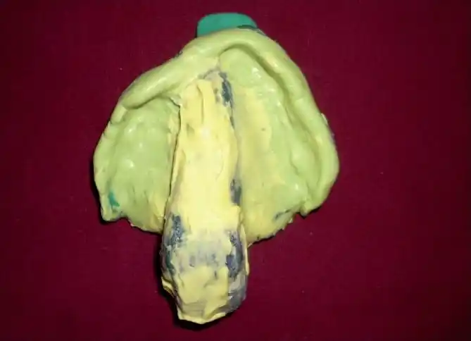 rehabilitation of patient with acquired maxillary defect, using