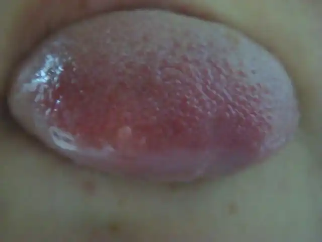 舌头起泡 照片 球高人指点