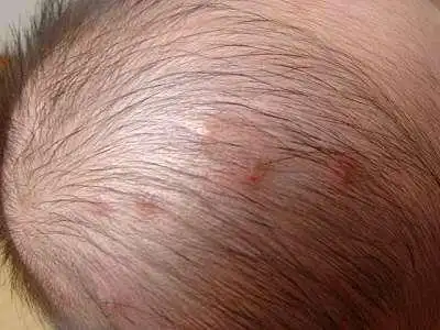 在线求助,宝宝头上长了很多痘痘!急急!