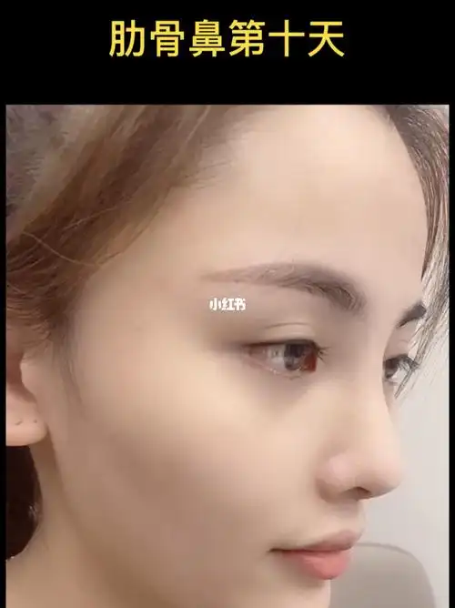 妈生自然鼻第十天