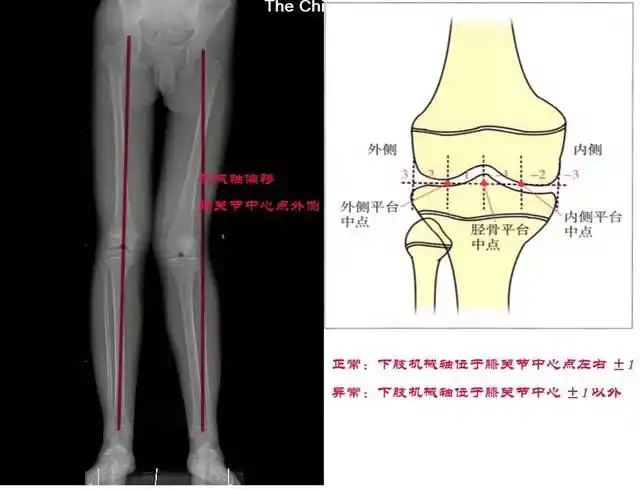 将膝关节进行6等分,正常下肢机械轴应该位于膝关