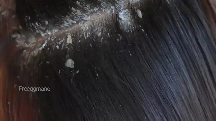 严重的头皮屑是这样的