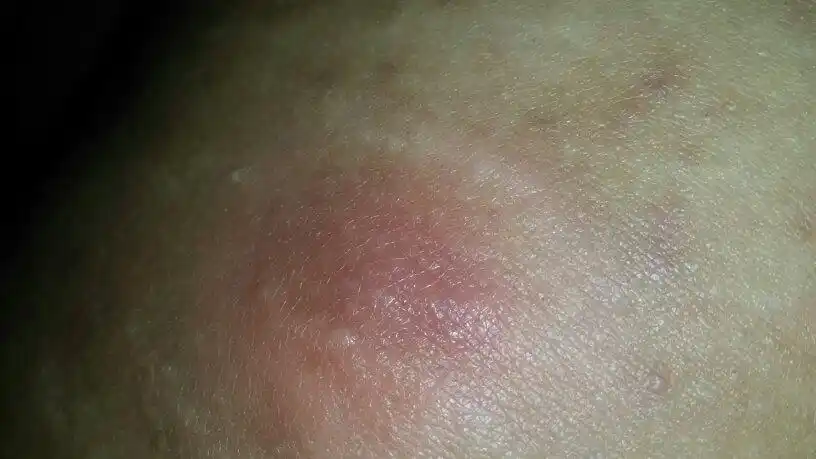 大腿外侧起了一个疹子不知道是什么,一碰会疼,硬 ,仔细摸摸会觉得中间