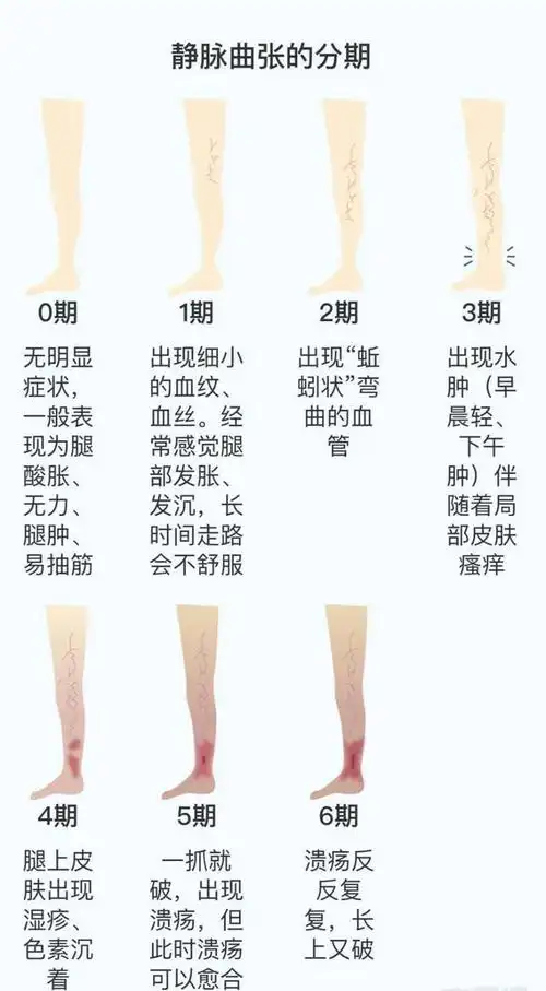 治疗下肢静脉曲张的六大法宝