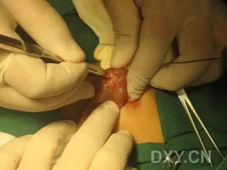 【资料】一例尿道下裂手术经过(多图)