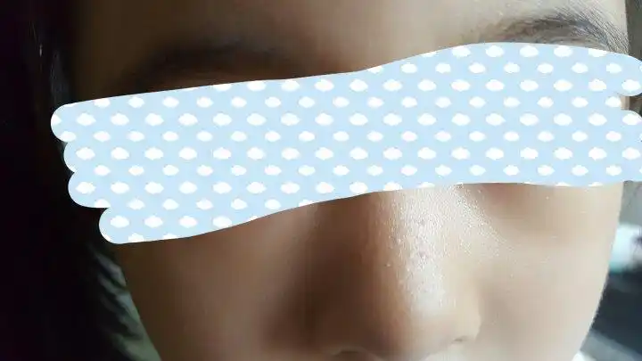 宝宝夏季鼻子上起这样的小疙瘩,不疼也不痒,是怎么回事,要用什么药呢?