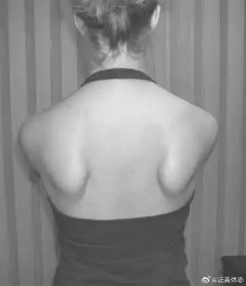 圆肩驼背富贵包,教你这样消除它 先给大家推荐一个矫正动作:圆肩驼背