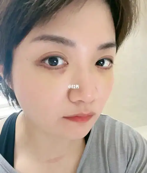 眼袋外切手术的第5天