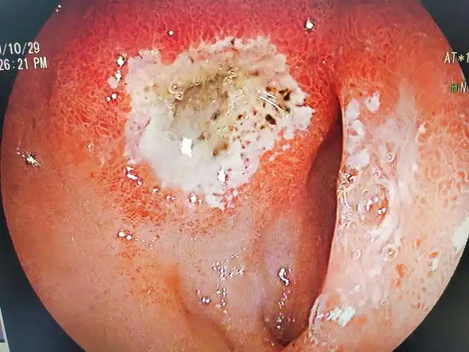 内镜下溃疡合集