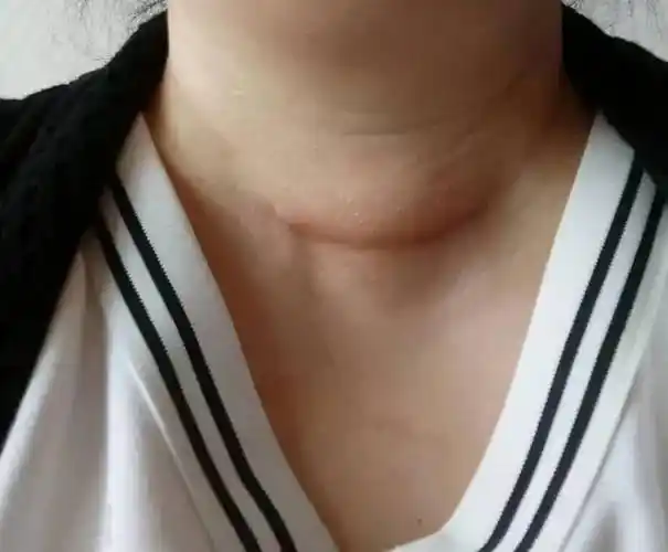 30岁的马女士10年桥本病伴结节病史差一步就发展成甲状腺癌