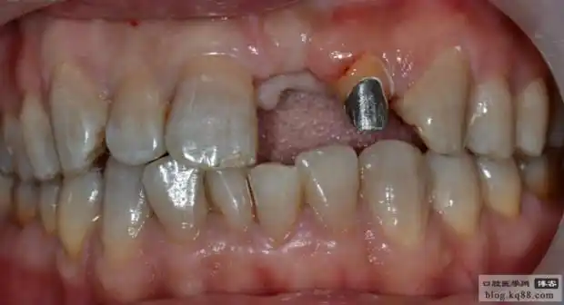 体验氧化锆全瓷的遮色效果