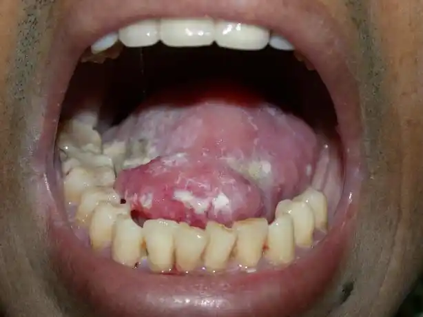 口腔癌病人的 命运 自杀,心转,改过 他原则答应,但似乎很勉强也