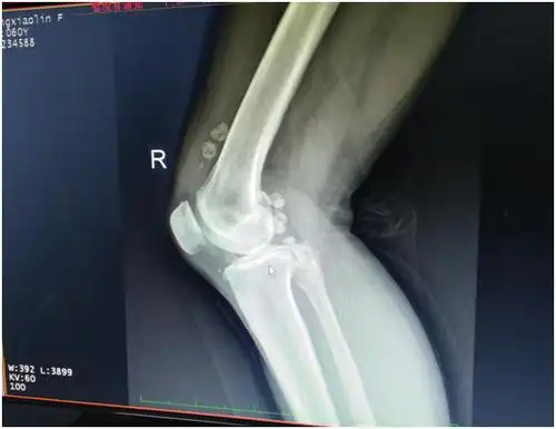 【骨科】"关节鼠"作祟多年,关节镜一举"除害"助健康!