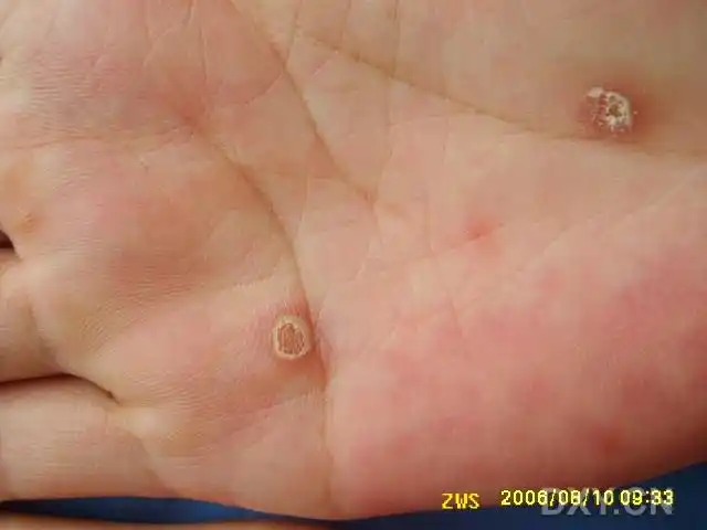 有吸毒史.查:rpr: :128( ),tppa( ).