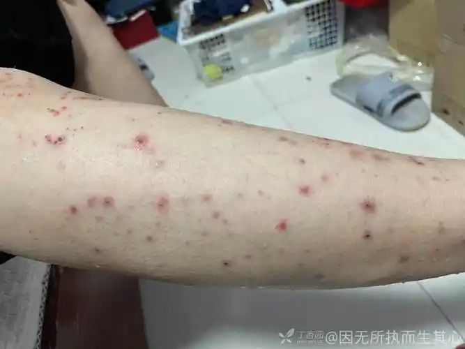 53岁小腿上起了红斑很痒不知道是什么疾病该怎么治疗