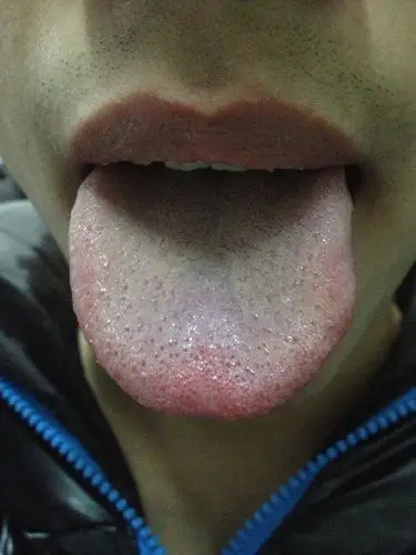 我这舌头红点是怎么回事? 这正常吗?