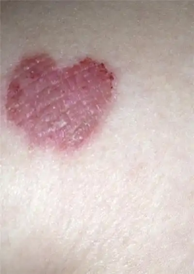 花斑癣早期图片 (36)_有来医生