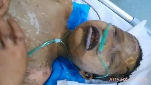 兄妹被人强灌硫酸女童惨死 男童被腐蚀皮肤黑青面目全非