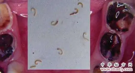 偏方治病牙,虫子往外爬! - 口腔科 - 中华秘方网