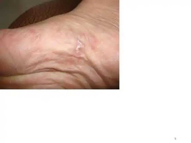 典型二期梅毒一例