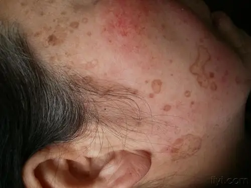 典型病例一天后公布答案(汗孔角化症)