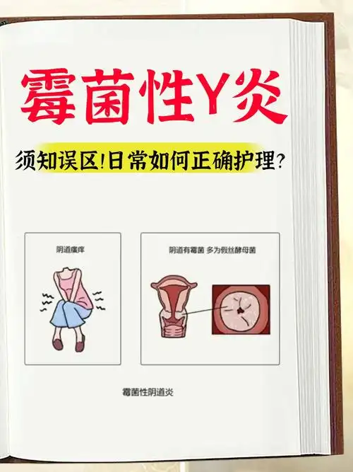 在平时女性若没有做好s处护理的工作,容易遭受霉菌性y道炎的袭击,不适