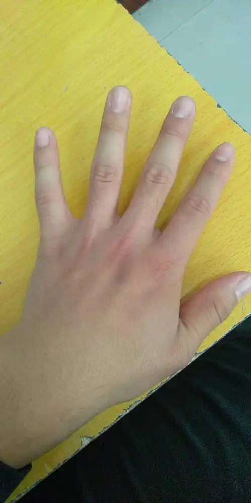 左手 手背中指旁边 一块发黑