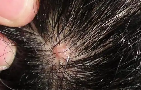 头皮小肿块十年后一查竟是恶性肿瘤 癌征兆有哪些