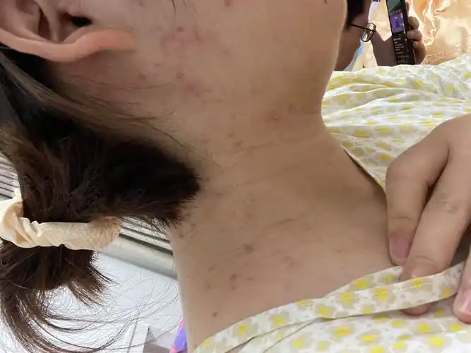 孕晚期肚子痘痘越来越多了难受01