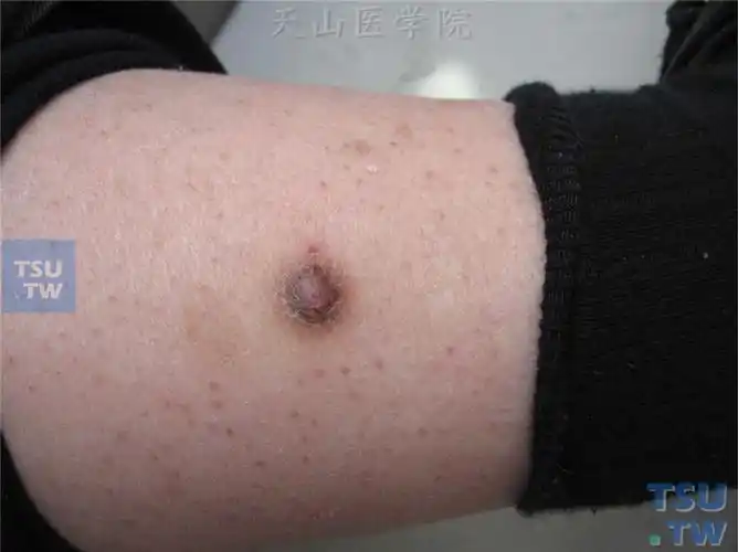 良性肿瘤:皮肤纤维瘤(dermatofibroma)症状表现 - 皮肤病学 - 天山