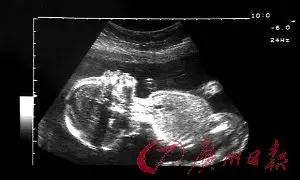 美国一项研究发现:女胎比男胎更容易胎死腹中