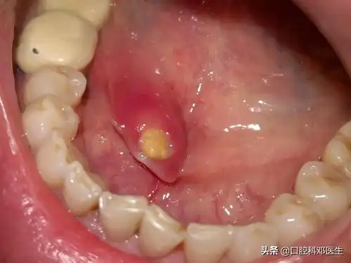 嘴里也长这么大的结石