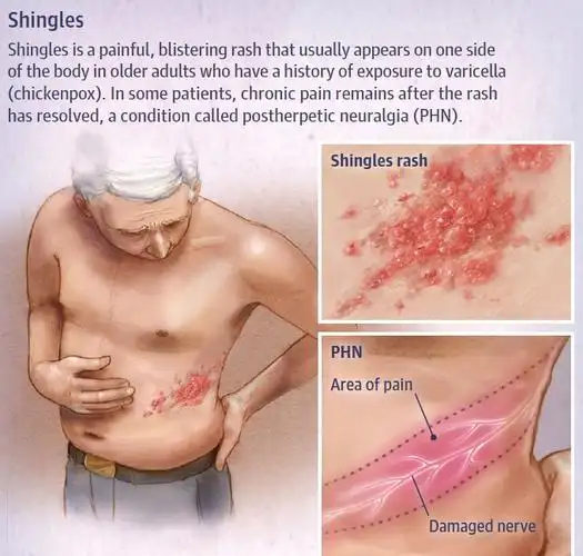 这种神经痛症状可见于发疹前,发疹时或疱疹消退后(带状疱疹后神经痛