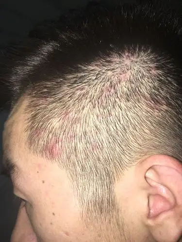 头皮起红色痘痘,有的会成浓包.一年多了.