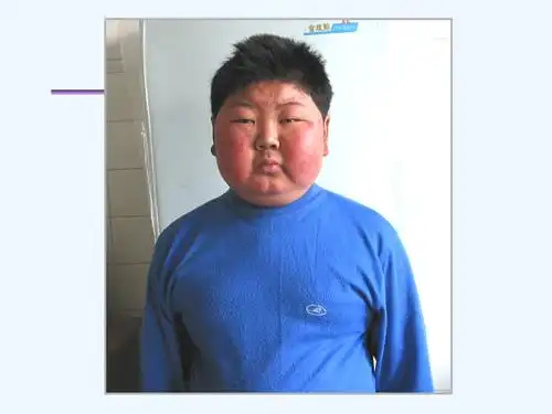 cushing综合征ppt课件