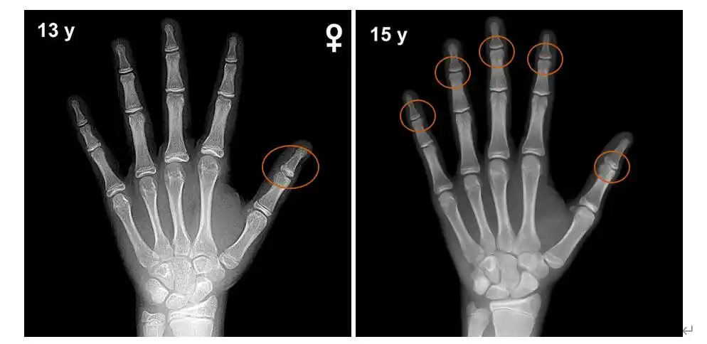 (开始闭合的骨骺.