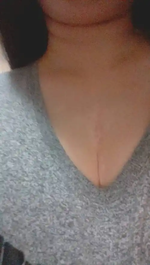 胸前手术疤可怕吗?会把男人吓跑吗?