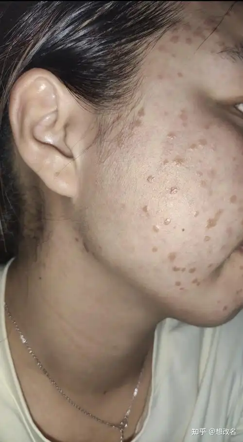 扁平疣爆发一年后