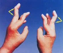 图1 晚期类风湿关节炎患者的"天鹅颈"畸形