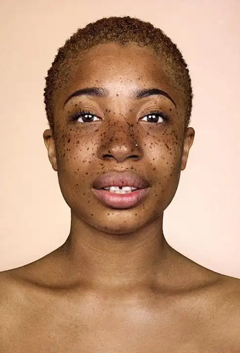 患上雀斑为何难治