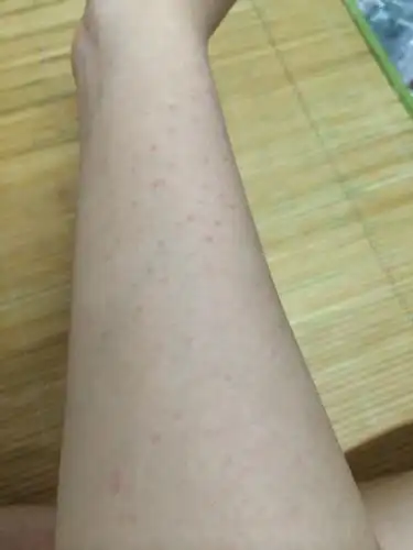 刚刚发现手臂上出现这些小红点 是突然间有的 不痛不痒 怎么回事阿?