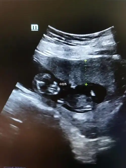 14周拍的,有会看性别的吗97_孕产_母婴_母婴_孕产经验